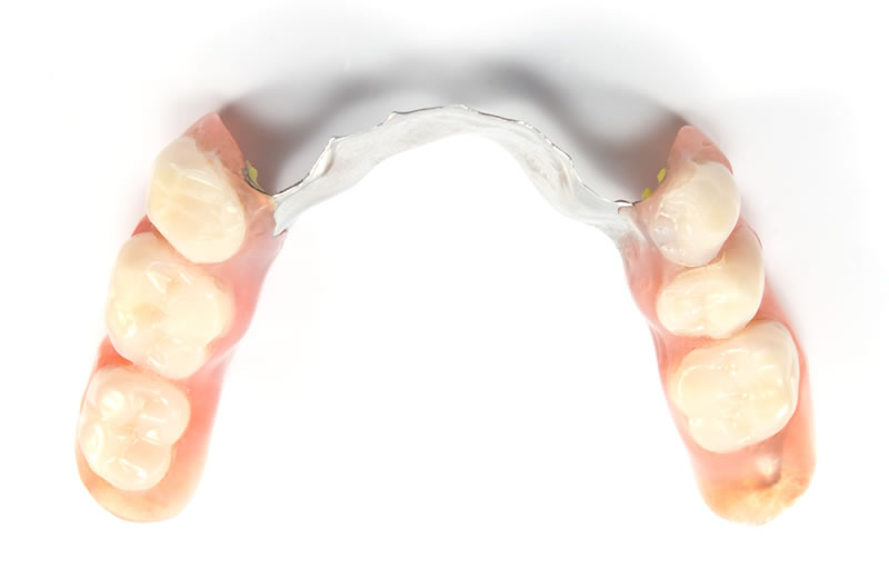 画像：金属床義歯 (部分入れ歯)