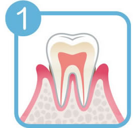 軽度の歯周病